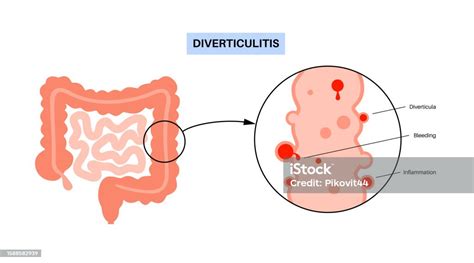 diverticulosis wikipedia|diverticulosis anatomy.